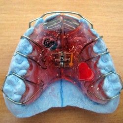 Izrada mobilnih proteza za zube