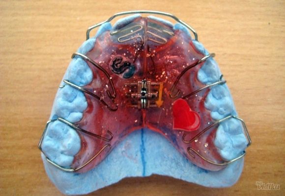 Izrada mobilnih proteza za zube