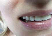 Navlake za zube - Stomatoloski centar Jovsic