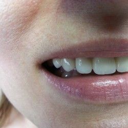 Navlake za zube - Stomatoloski centar Jovsic