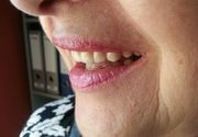 Bezmetalne Krunice za zube - Stomatoloski centar Jovsic