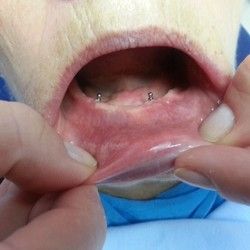 Zubni Implanti - Stomatoloski centar Jovsic