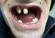 Vadjenje Zuba - Stomatoloski centar Jovsic