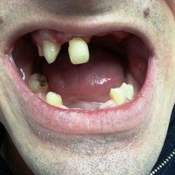 Vadjenje Zuba - Stomatoloski centar Jovsic