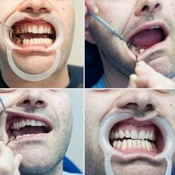 Popravka zuba - Stomatoloski centar Jovsic