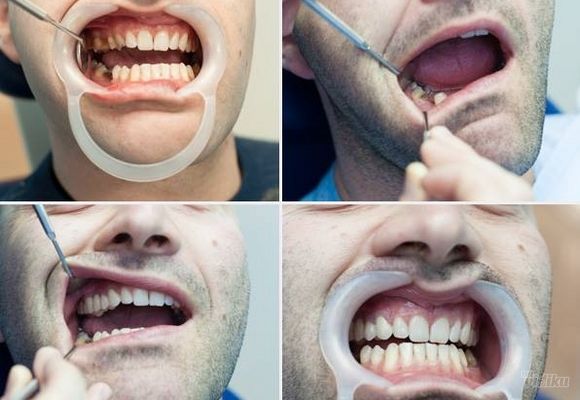 Izbeljivanje zuba - Stomatoloski centar Jovsic