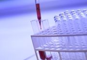 Analiza krvi - Hb Hemoglobin - Aqualab Plus Laboratorije