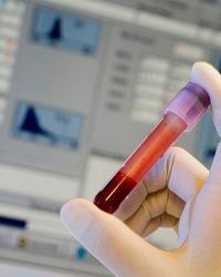 Analiza krvi - HCT Hematokrit - Aqualab Plus Laboratorije