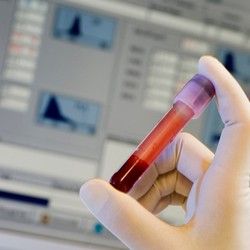 Analiza krvi - HCT Hematokrit - Aqualab Plus Laboratorije