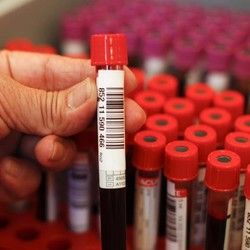 Analiza krvi - S-alfa amilaza - Mikrobiološka Laboratorija Marković