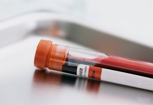 Analiza krvi - U-alfa amilaza - Mikrobiološka Laboratorija Marković