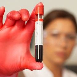 Analiza krvi - Natrijum - Mikrobiološka Laboratorija Marković