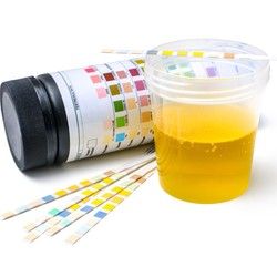 Analiza urina - izgled mokraće - Laboratorija Analiza 3