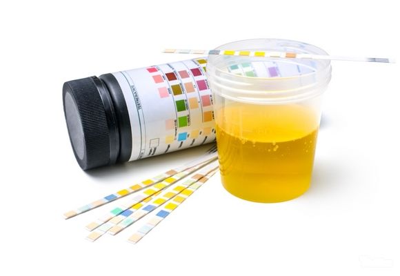 analiza-urina---izgled-mokrace---laboratorija-analiza-3.jpg