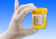 Analiza urina - boja mokraće - Laboratorija Analiza 3