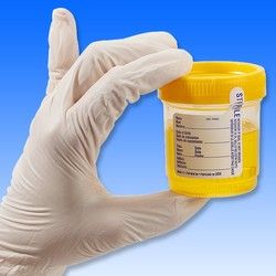 Analiza urina - boja mokraće - Laboratorija Analiza 3