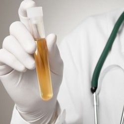 Analiza urina - Urobilinogen u mokraći - BioDiagnostica Laboratorija