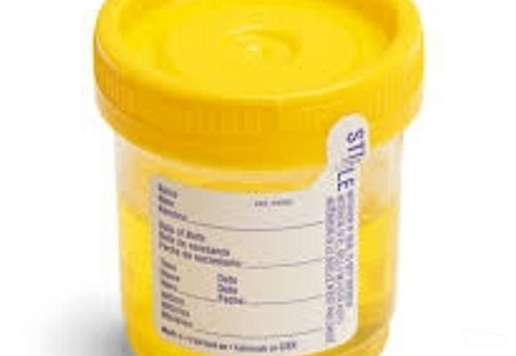 Analiza urina - Nitriti u mokraći - BioDiagnostica Laboratorija