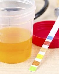 Analiza urina - Eritrociti u mokraći - BioDiagnostica Laboratorija