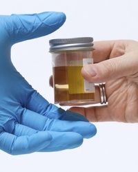 Analiza urina - Leukociti - bela krvna zrnca u mokraći - BioDiagnostica Laboratorija