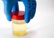 Analiza urina - Urati amforni u mokraći - Laboratorija Urolab