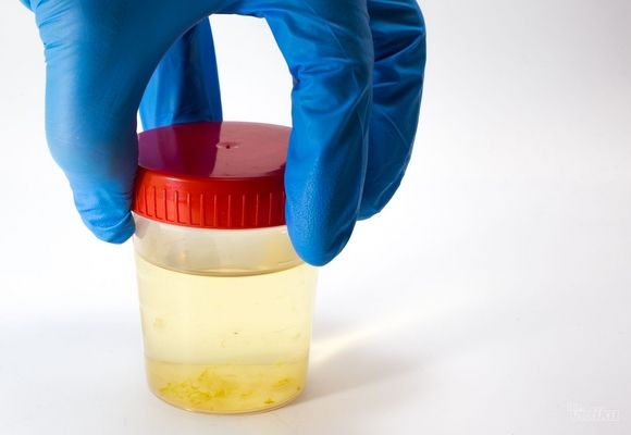 Analiza urina - Urati amforni u mokraći - Laboratorija Urolab