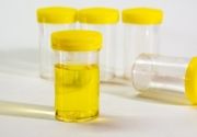 Analiza urina - Sluz u mokraći - Aqualab Plus Laboratorije