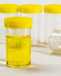 Analiza urina - Sluz u mokraći - Aqualab Plus Laboratorije