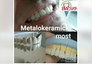 Metalokeramicki most