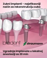 Implanti - Dr Minic
