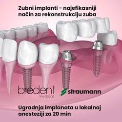 Implanti - Dr Minic
