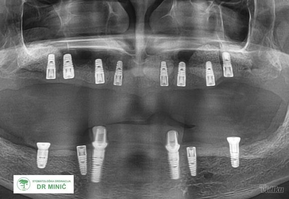 implanti---dr-minic-7983b5-8b66d323-1.jpg
