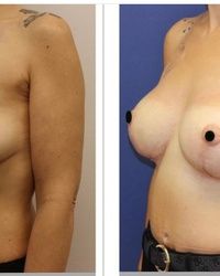 Podizanje grudi implantatima Vracar