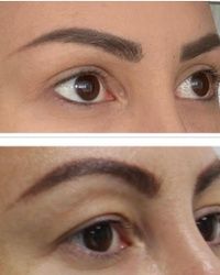 Blefaroplastika Vracar
