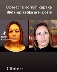Korakcija kapaka Vracar