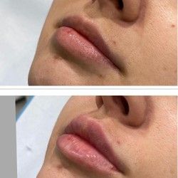 Uvecanje usana Vracar