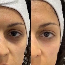 Biorevitalizacija podočnjaka Kragujevac