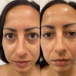 Naši pacijenti obožavaju biorevitalizaciju podočnjaka! ⁣