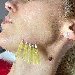 Tretmani podmladjivanja lica mezonitima, Kragujevac