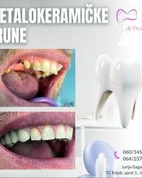 Metalokeramicke krune Blok 45