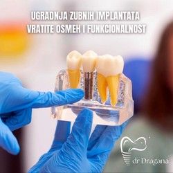 Zubni implanti Blok 45