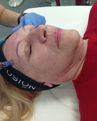 Dermapen Mirijevo
