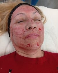 Dermapen tretman lica Mirijevo