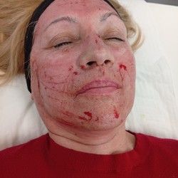 Dermapen tretman lica Mirijevo