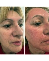 Dermapen tretman pre i posle