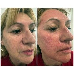 Dermapen tretman pre i posle