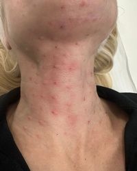 Biorevitalizacija vrata Mirijevo
