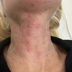 Biorevitalizacija vrata Mirijevo
