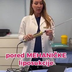 Vibraciona liposukcija Beograd