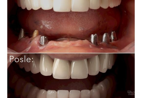 bezmetalne-krune-na-implantima-40413f.jpg